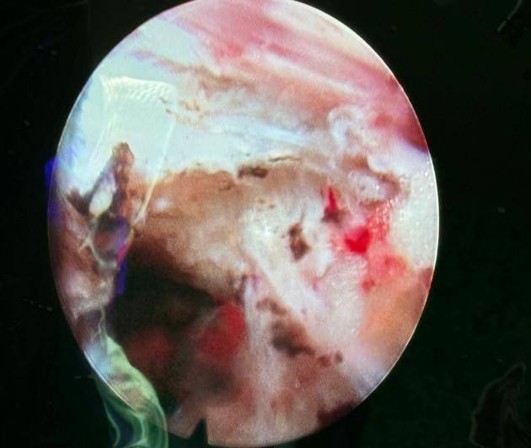 Endoscopic Spine Surgery
