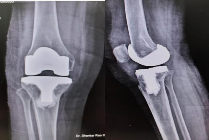 Post operative radiograph of Total knee replacement [TKR]