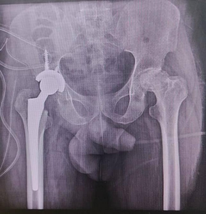 Post operative radiograph of Total HIP replacement [THR]